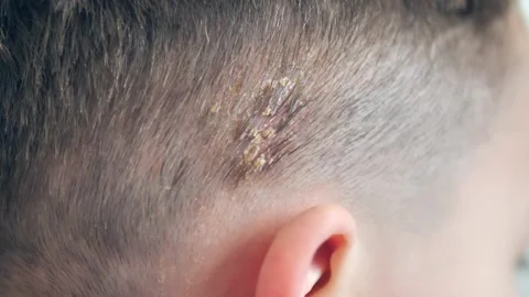 Host formation on the scalp of babies, close-up of host disease on the scalp, 動画素材 261291596