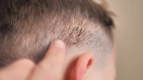Host formation on the scalp of babies, host disease on the scalp, 스톡 동영상 261291641