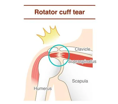 How and why shoulder rotator cuff tears occur Stock-Illustration