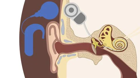 How the cochlear implant system works and ear anatomy Stock Illustration