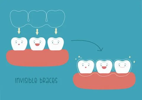 How to of invisible braces by tooth concept Illustrator Stock Illustration