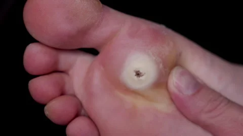 HPV wart plantar wart close up bottom of the foot. Stock Footage 285368367