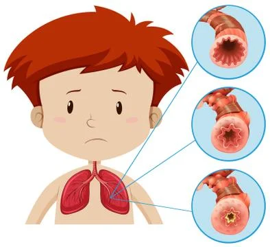 A Human Anatomy of Lung Problem Stock Illustration