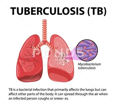 Human Anatomy of Lung with Tuberculosis Infographic: Graphic #253258965