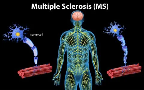 Human Anatomy of Multiple Sclerosis Stock Illustration