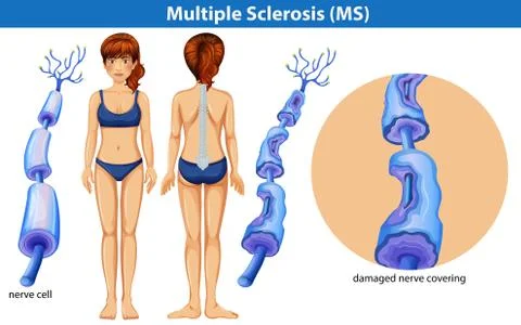A Human Anatomy of Multiple Sclerosis Stock Illustration