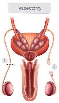 Human Anatomy of  Vasectomy on White Background Stock Illustration