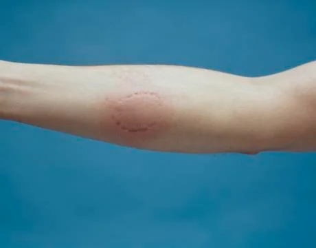 Human arm with bite mark Foto stock