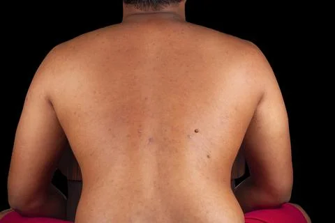 Human back skin texture. pimples on skin micro photo. close up photo. Фото