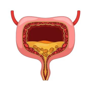 Human bladder cross-section with urinary stones 2D vector illustration Illustrazione stock