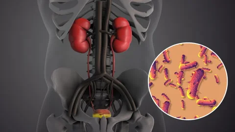 Human Bladder Inflammation Caused by Bacteria Stock Footage 307019878