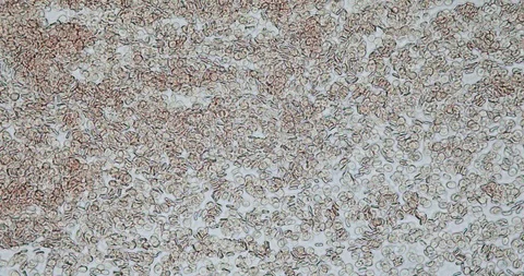 Human blood in microscope Stock Footage 129409026