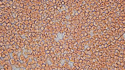 Human blood under a microscope. You can see erythrocytes - red blood cells. T Stock Photos