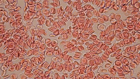 Human blood under a microscope. You can see erythrocytes - red blood cells... Stock Photos