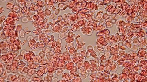 Human blood under a microscope. You can see erythrocytes - red blood cells... Stock Photos