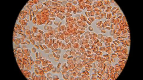 Human blood under a microscope. You can see erythrocytes - red blood cells... Stock Photos