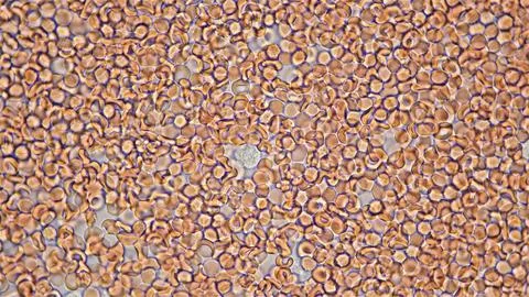 Human blood under a microscope. You can see erythrocytes - red blood cells... Stock Photos