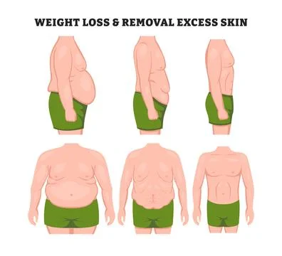 Human body problem after Weight loss, excess skin removal in man with front.. Stock Illustration