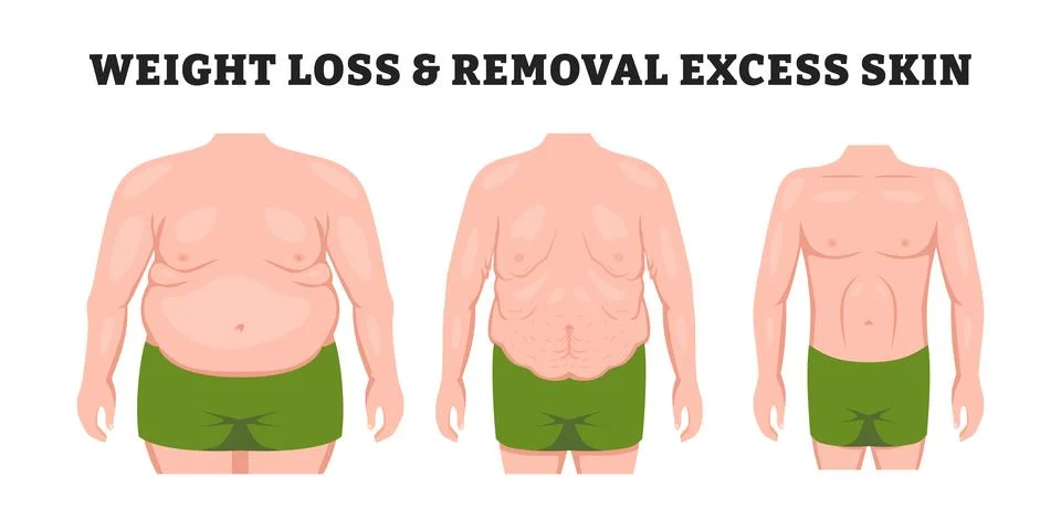 Human body problem after Weight loss, excess skin removal in man with front.. Stock Illustration
