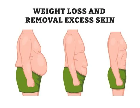 Human body problem after Weight loss, excess skin removal in man with side .. Stock Illustration