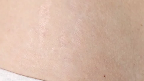 Human body with scars and stretch marks close-up. Violation of skin elasticity. Stock Footage 180905827