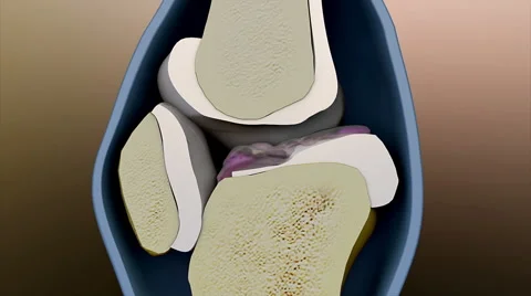 Human bone, arthritis Stock Footage 57823535