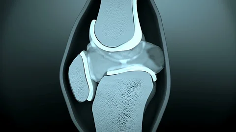 Human bone destruction Stock-Footage 117237295