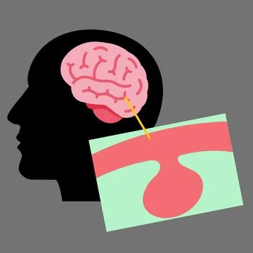 Human brain with aneurysm condition useful for healthcare industry Stock Illustration