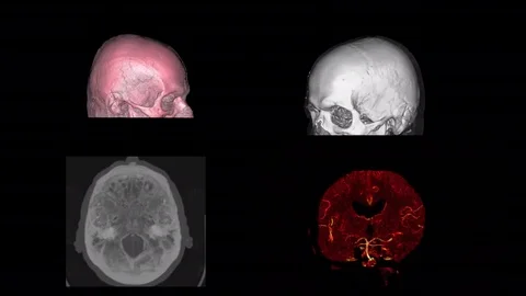 Human Brain CT Scan 4 video Stock Footage 81522273