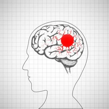 Human brain inside the head. Migraine disease. Illustrazione stock