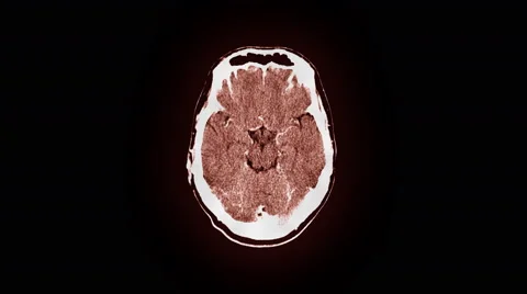 Human Brain MRI Scan Stock Footage