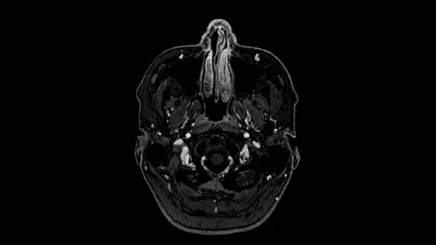 Human brain MRI scan, Gradient echo axial T1, infused Gadolinium, Imaging Stock Footage 124324483