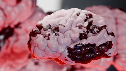Human brain nervous system anatomy, neural cancer, Sebaceous bulb, malignant Stock Footage 287095909