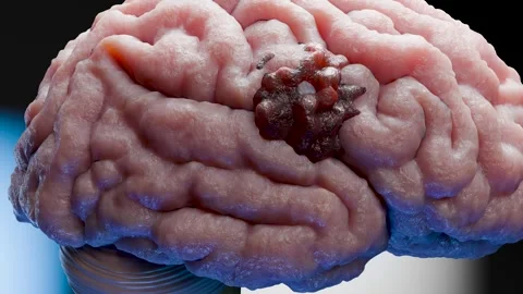 Human brain nervous system anatomy, neural cancer, Sebaceous bulb, malignant Stock Footage 287849225