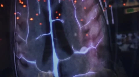 Human Brain Scan on large plasma screen Stock Footage 56370955