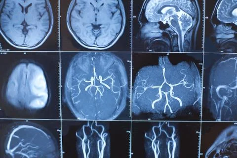 Human brain x-ray perspective photo Stock Photos