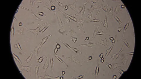 Human cancer cells Stock Footage 88973111