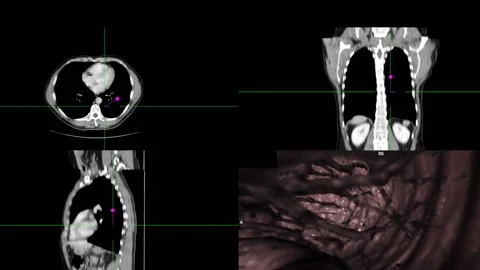 Human chest - abdomen Endoscopy  - Full HD - ProRes Stock Footage 164862341