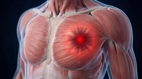 Human chest area with red highlight, illustrating pain in pectoral muscle o.. Stock Illustration