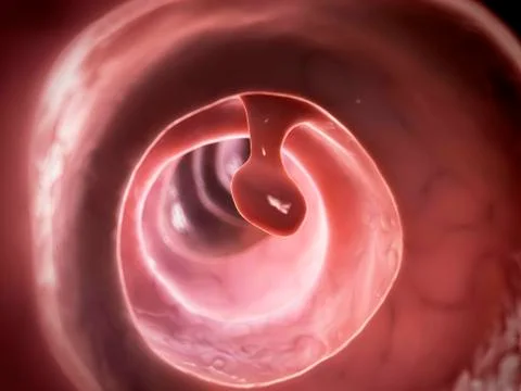 Human colon polyp, illustration Stock Illustration