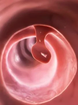 Human colon polyp, illustration Stock Illustration