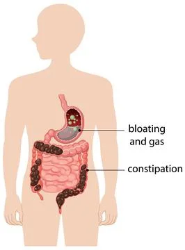 Human Digestive System with Bloating and Constipation Stock Illustration