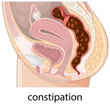 Human Digestive System with Constipation Illustration Stock Illustration