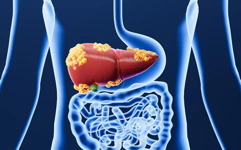 Human digestive system, fatty liver. 3d rendering. Stock Illustration