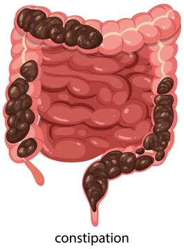 Human Digestive System Illustration with Constipation Focus Illustrazione stock