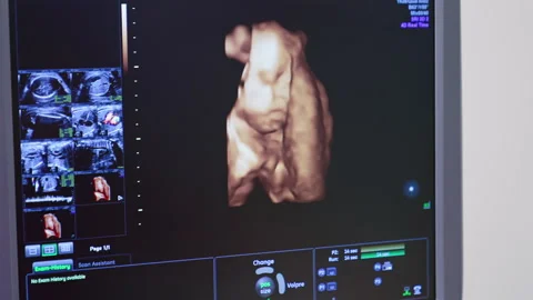 Human embryo is moving his head on an ultrasound display. Ultrasound monitor  Stock Footage 159864735