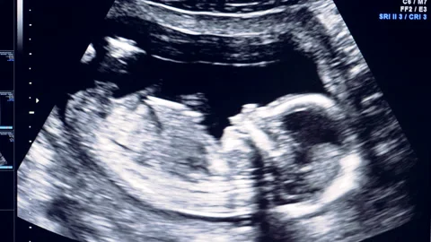 Human embryo is slightly moving his head on an ultrasound display Video stock 88207073