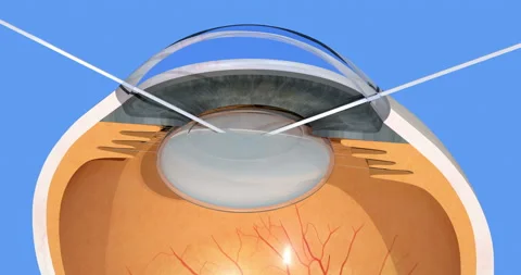 Human eye, cataract surgery, manual cloudy lens fragmentation, 3d render, 4K Stock Footage 89760352