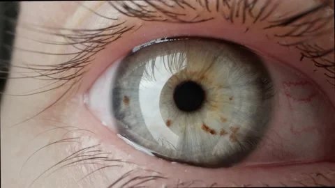 Human eye with iris nevi | Stock Video | Pond5