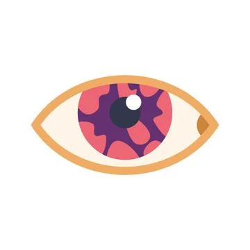 Human eye showing symptoms of conjunctivitis infection Stock Illustration